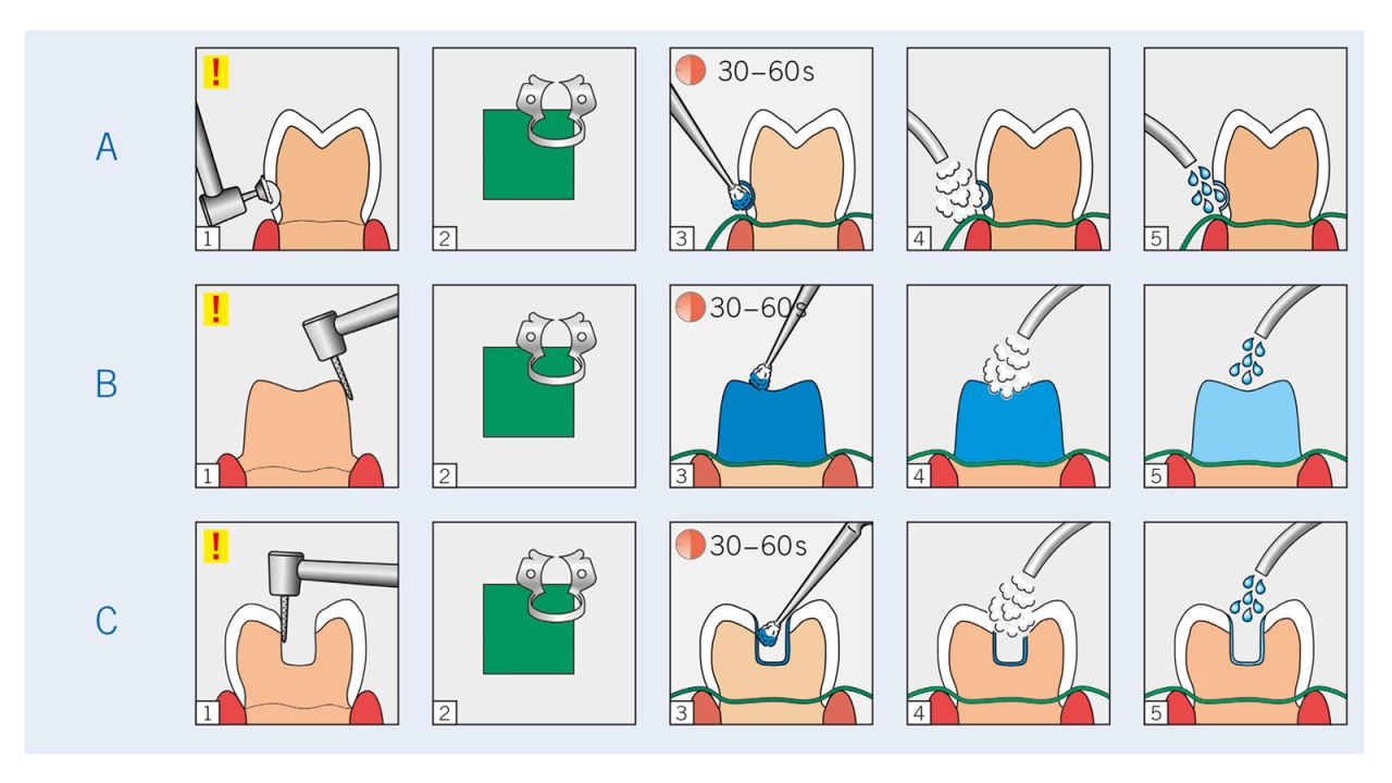 GLUMA Desensitizer più guadagno, meno dolore.